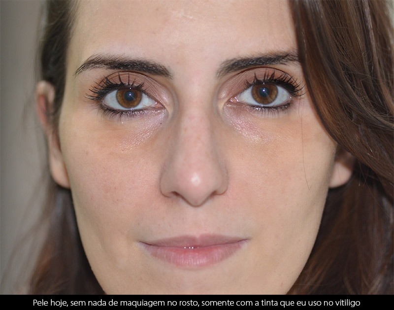 Antes e Depois do meu tratamento de Melasma com laser Spectra Nd:YAG Q-Switched