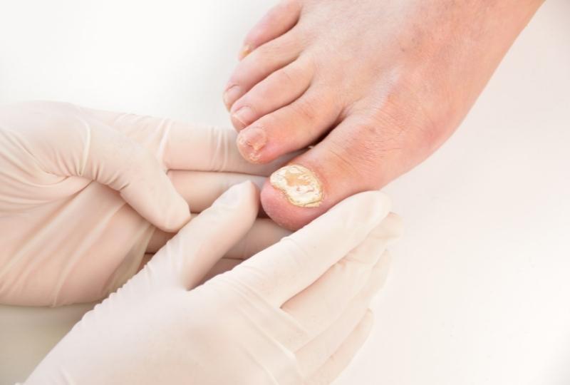 micose nos pés e dermatologista