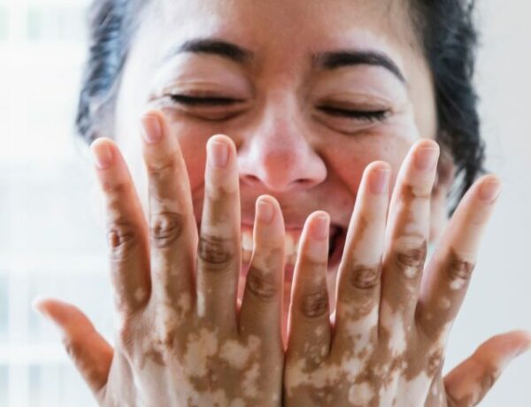 mulhe com vitiligo