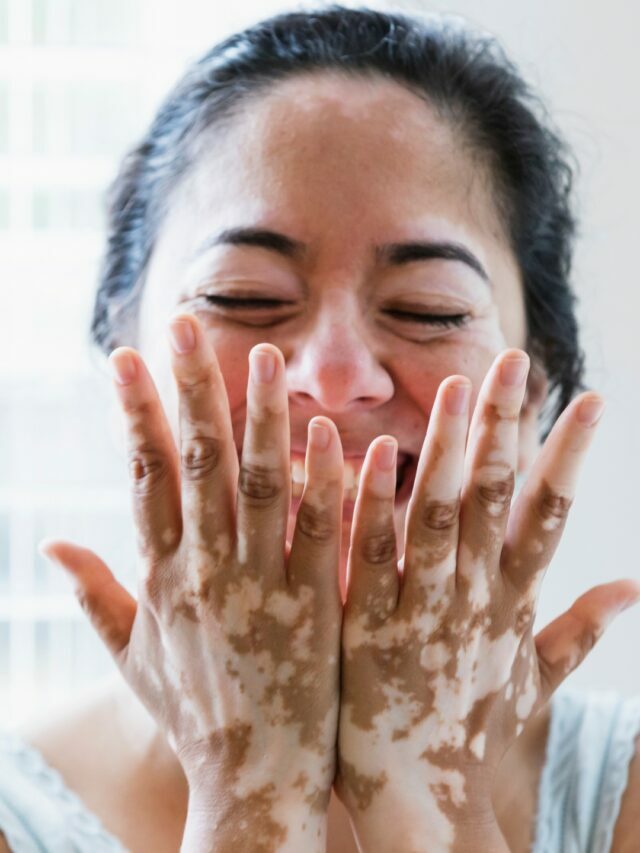 Você realmente conhece o vitiligo?